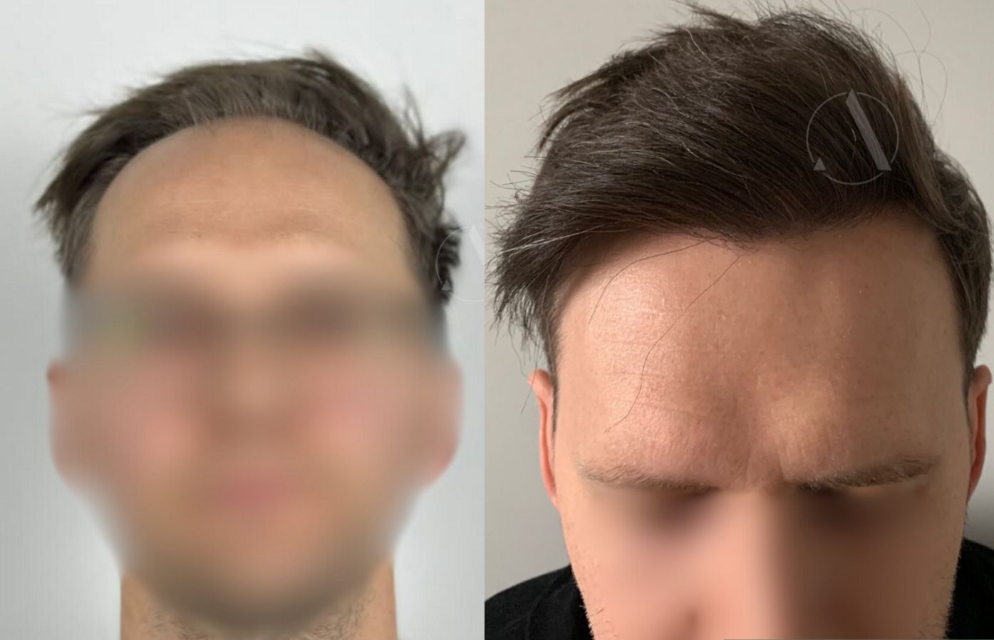 caso-dr-ahmed-altan-3700-grafts-fue-12-mesi-scala-nw-iii