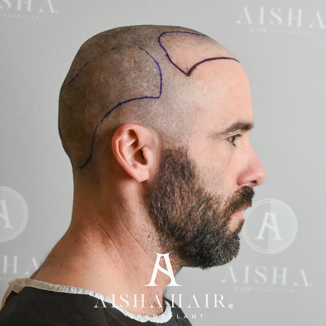 CASO AISHA HAIR TRANSPLANT - 3000 GRAFTS FUE