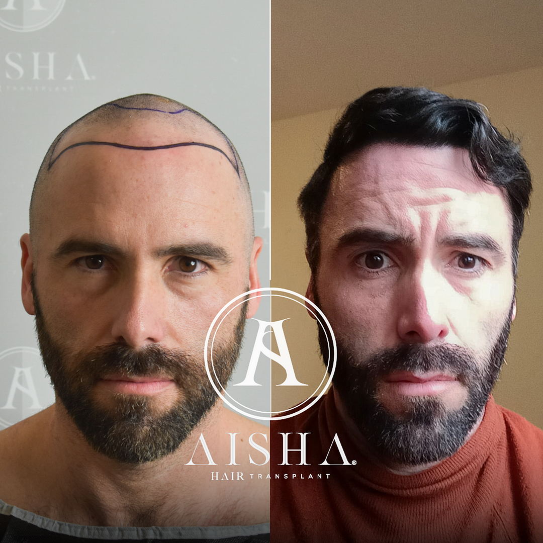 CASO AISHA HAIR TRANSPLANT - 3000 GRAFTS FUE
