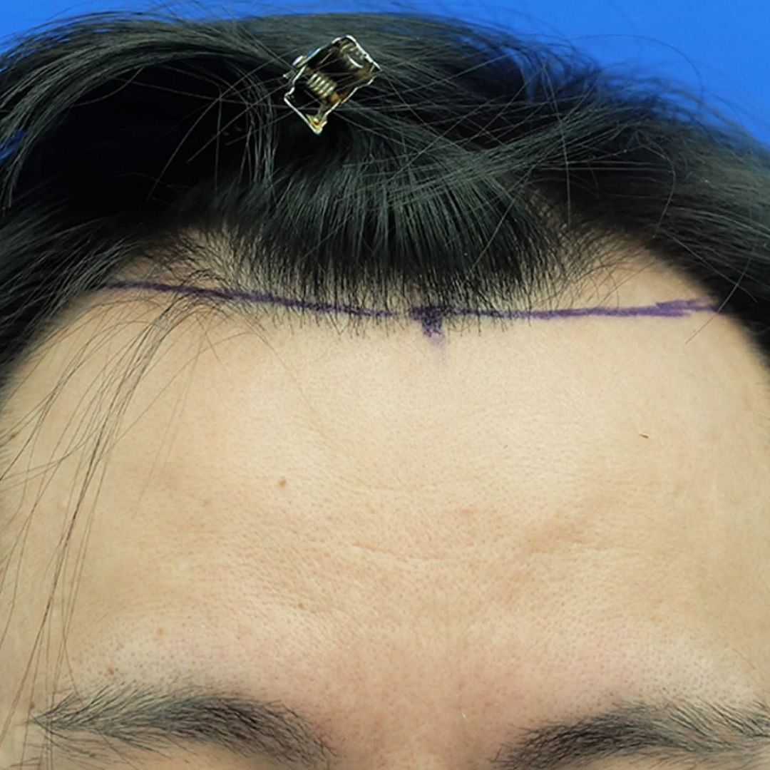 CASO DR.WONG - 1581 GRAFTS FUE Bellicapelli Forum