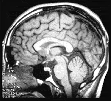 MRI scan of the author, circa 1995