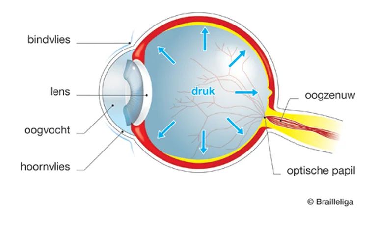 Anatomisch diagram van een oog met glaucoom