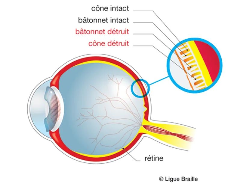 Schéma anatomique d'un oeil avec retinite pigmentaire