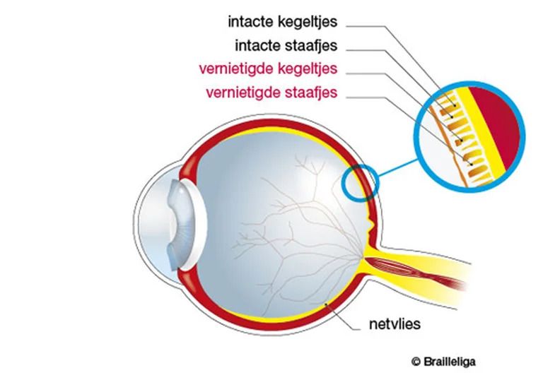 Anatomisch diagram van een oog met retinitis pigmentosa