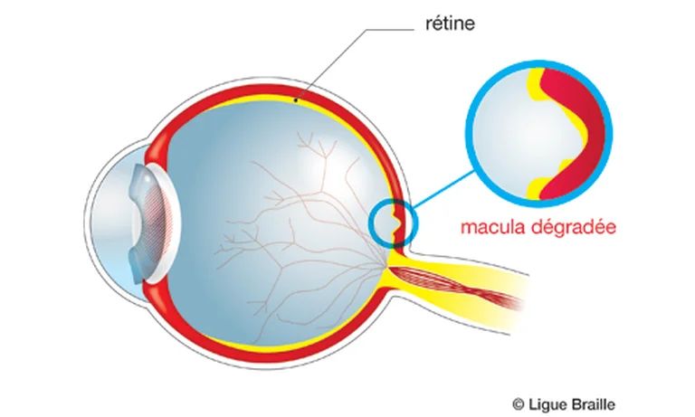 Schéma anatomique d'un oeil avec dégénérescence maculaire