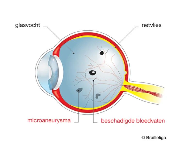 Anatomisch diagram van een oog met diabetische retinopathie