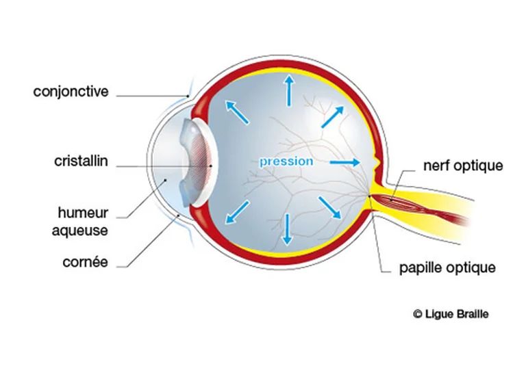 Schéma anatomique d'un oeil avec glaucome