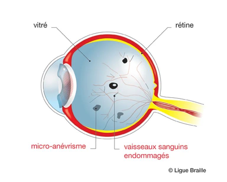 Schéma anatomique d'un oeil avec rétinopathie diabétique