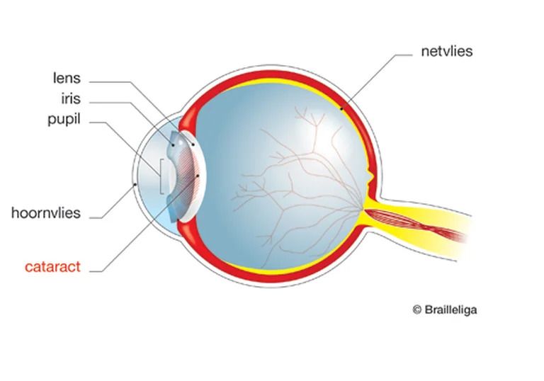 Anatomisch diagram van een oog met cataract