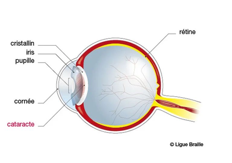 Schéma anatomique d'un oeil avec cataracte 