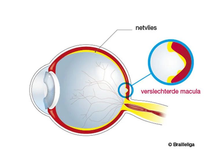 Anatomisch diagram van een oog met maculadegeneratie