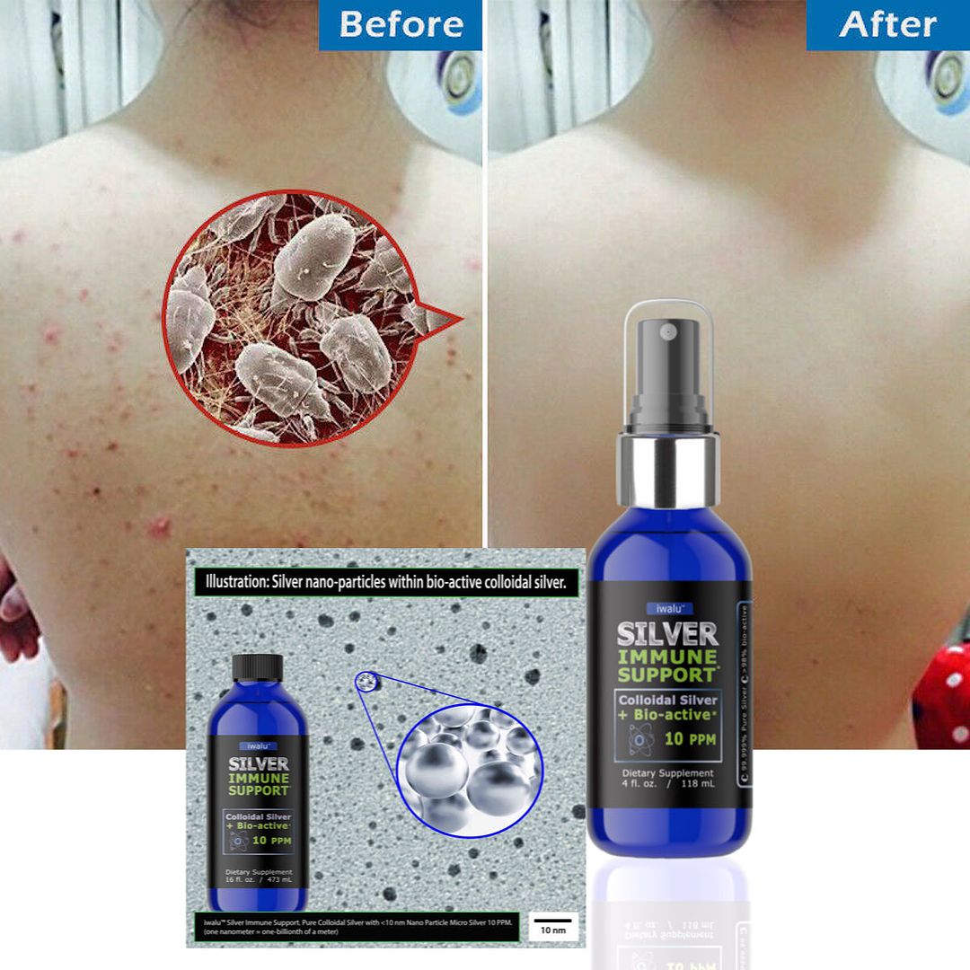 doctor_recommended_acne_remedy_anti_bacterial_anti_inflammatory_bacteriacide_agent_colloidal_silver_treatment