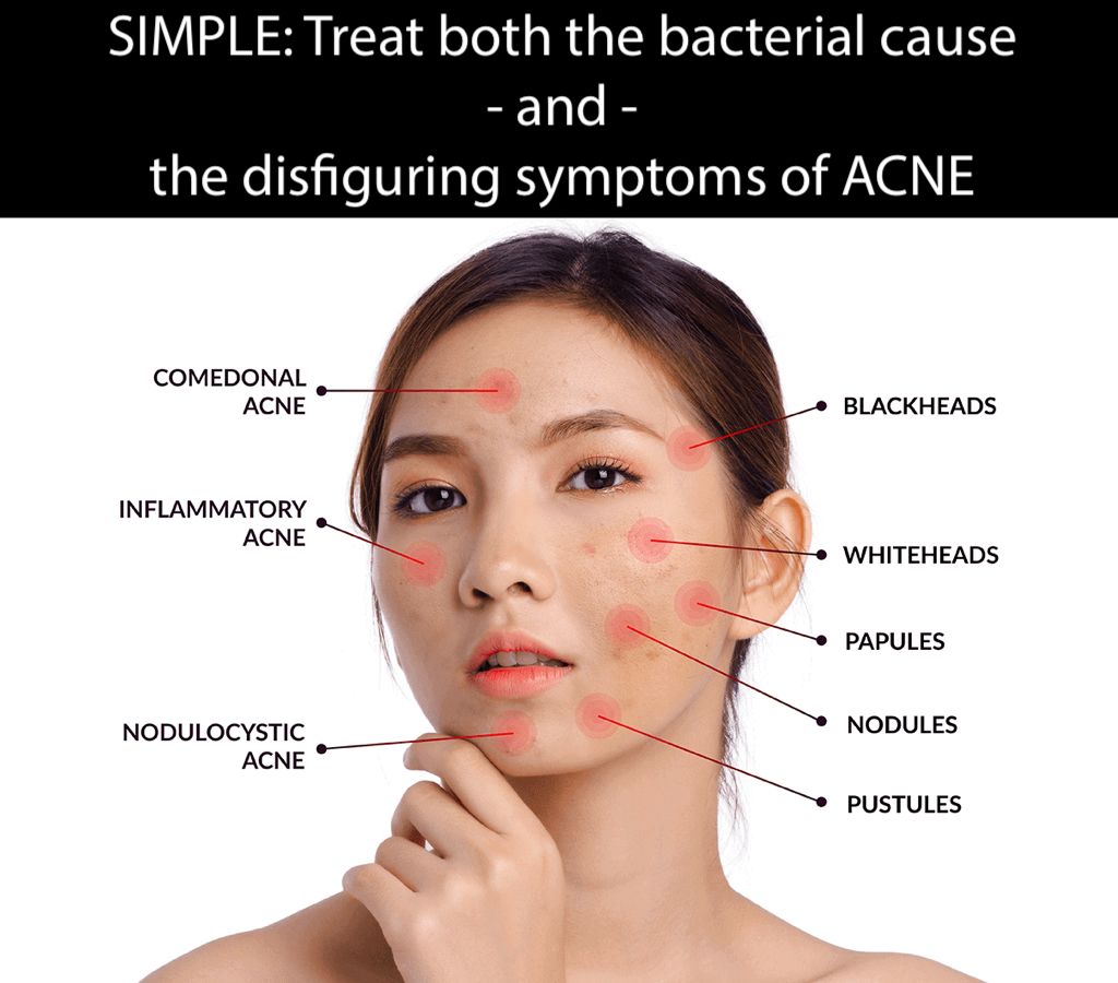 fast acting doctor recommended clear acne remedy anti bacterial anti_inflammatory_bacteriacide_agent_colloidal_silver_treatment
