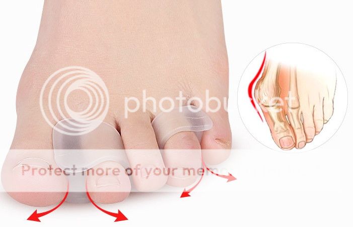 【订:7月上旬】$15 团购新款双环拇外翻重叠趾分趾器1套2个,双环设计