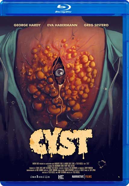 cyst